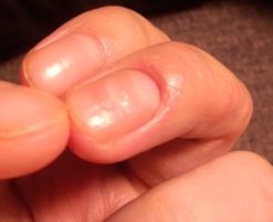 爪のへこみ｜病気のサイン？親指や根元にできる凸凹の正体と対処法